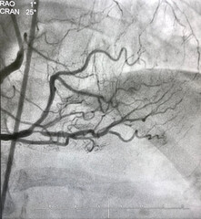 coronary angiogram showed right coronary artery (RCA) given collateral to left anterior descending artery (LAD) that had chronic total occlusion (CTO).