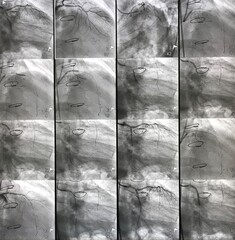 percutaneous coronary intervention at left coronary artery in patient that undergoing open heart...