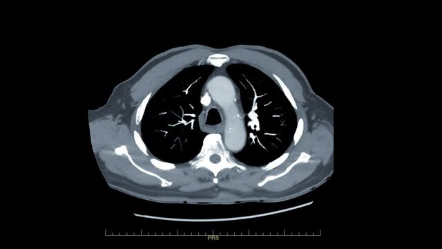 CTA Chest or CTPA with contrast media Axial MIP view for diagnostic Pulmonary embolism (PE) and lung cancer .