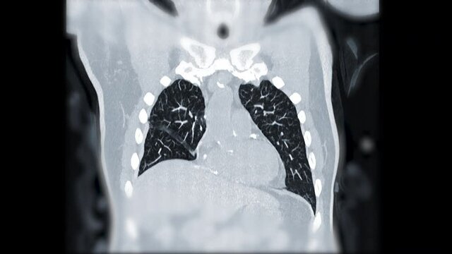 CT Chest Lung window Coronal view for diagnostic Corona virus or covid19 and lung disease.