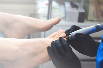 Professional podiatric therapy with a podiatry drill machine. Chiropody. Foot care.