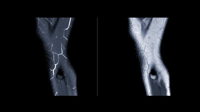 MRI Knee  joint or magnetic resonance imaging of the knee compare sagittal plane T2W and  PDW  for diagnosis sport trauma and damage of cross-shaped ligaments .