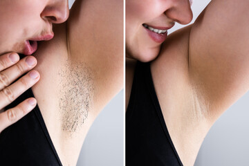 Before After Laser Hair Removal