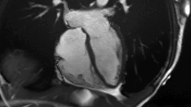 Cardiac MRI of beating heart.  Seamless looping.