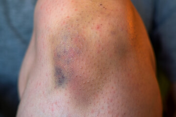 Fototapeta premium Bruise injury on knee. Close up image of person sitting on sofa and holding in hands wounded leg with hematoma.