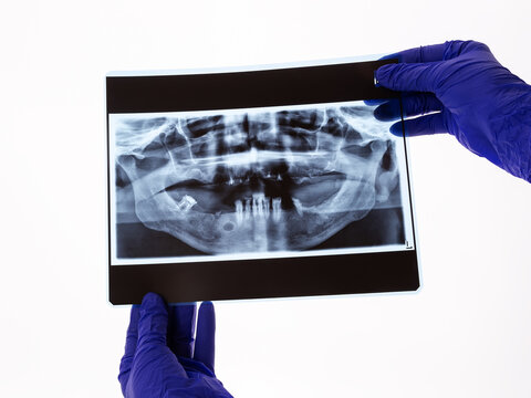The dentist hands holding the panoramic facial x-ray image of an old person with some lower teeth and no tooth of the upper. Original x-ray teeth scan for planning prosthetics. Dental check-up.