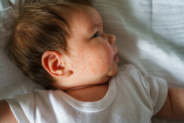 Neurodermatitis Chronic constitutional atopic eczema small newborn baby with dry skin problem on...