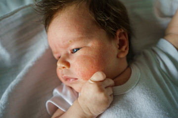 Neurodermatitis Chronic constitutional atopic eczema small newborn baby with dry skin problem on...