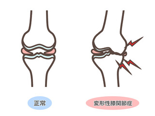 変形性膝関節症のイラスト