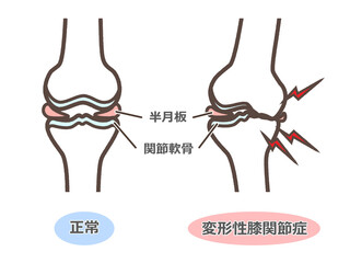 変形性膝関節症のイラスト