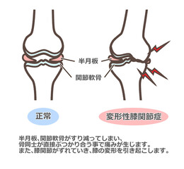 変形性膝関節症のイラスト