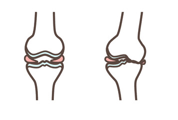 変形性膝関節症のイラスト