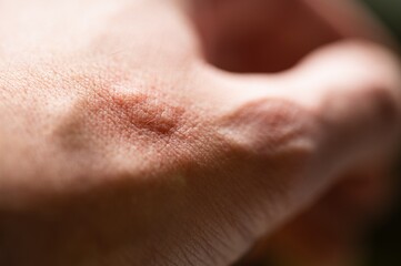 Allergic rash after contact allergy: pustules, spots, blisters and wheals on the skin as allergic reaction