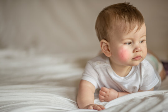 Atopic dermatitis eczema in baby.Condition that causes the skin to become red,dry,sore,itchy and cracked.Atopic eczema most often affects face in children.