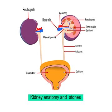 Kidney anatomy, and the formation of stones on  parts, 3d illustration
