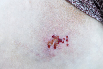 Woman with Shingles or Herpes Zoster on skin, it is raised red bumps and blisters caused on body. Medicine treatment for varicella-zoster virus infection concept. - obrazy, fototapety, plakaty