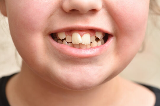 Crooked Teeth In A Child Girl, Close Up