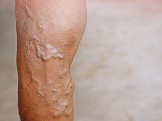 Fototapeta premium The severity of the varicose veins ranges from the tiny capillaries, pain in the legs, swollen feet and legs, and the crooked aneurysm resembles a worm.