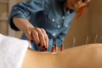 Therapy, treatment and alternative medicine concept. Close up of acupuncturist hand holding stick with dried plant heating surface of skin on back of patient, reducing pain or muscle tension