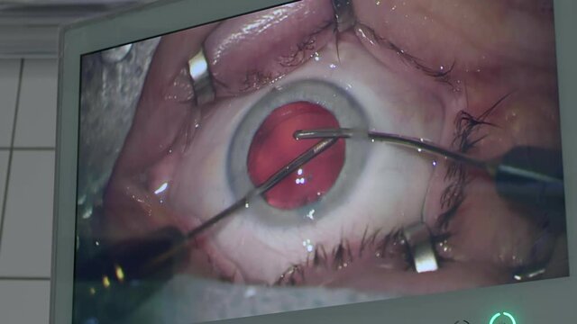 Close-up view of eye surgery on the monitor screen of surgical equipment in the operating room