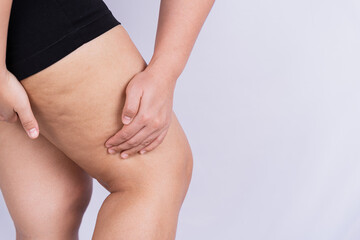 Female holding and pushing the skin of the legs cellulite or orange peel. Treatment and disposal of excess weight, the deposition of subcutaneous fat tissue