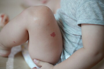 Hemangioma on baby boy's leg