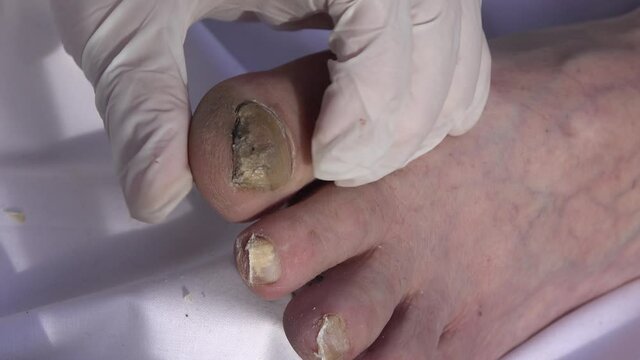 Toenails affected by fungus.