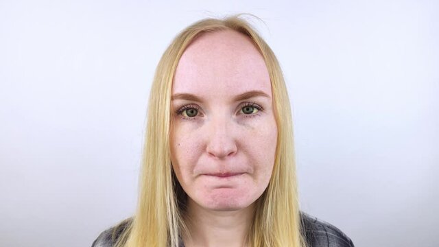 The yellow color of the woman eye. Symptom of jaundice, hepatitis or problems with the gall bladder, gastrointestinal tract, liver. Yellow eye in diseases of the liver, cirrhosis, hepatitis, bilirubin
