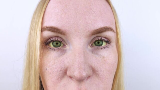 The yellow color of the woman eye. Symptom of jaundice, hepatitis or problems with the gall bladder, gastrointestinal tract, liver. Yellow eye in diseases of the liver, cirrhosis, hepatitis, bilirubin