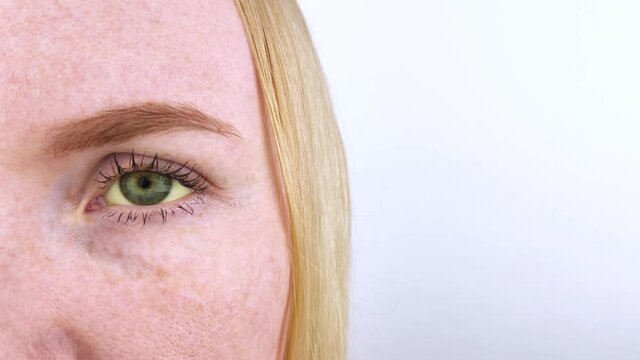 The yellow color of the woman eye. Symptom of jaundice, hepatitis or problems with the gall bladder, gastrointestinal tract, liver. Yellow eye in diseases of the liver, cirrhosis, hepatitis, bilirubin