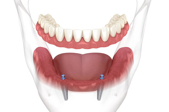 Mandibular removable prosthesis All on 2 system supported by implants with ball attachments. Medically accurate dental 3D illustration
