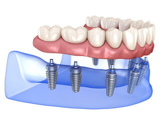 Maxillary and Mandibular prosthesis with gum All on 8 system supported by implants. Medically accurate 3D illustration of human teeth and dentures