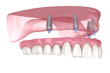 Maxillary prosthesis with gum All on 4 system supported by implants. Medically accurate 3D illustration of human teeth and dentures - 434249815