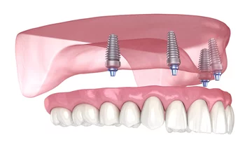 Fotobehang Maxillary prosthesis with gum All on 4 system supported by implants. Medically accurate 3D illustration of human teeth and dentures © Alex Mit