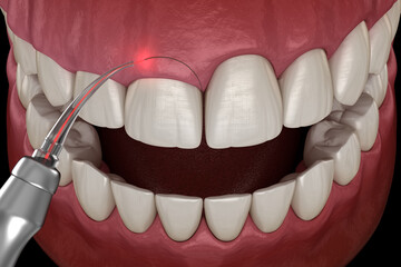 Gingivectomy surgery with laser using.  Medically accurate tooth 3D illustration - 434250445