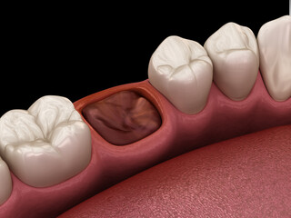 The blood clot seals off the tooth after extraction. Medically accurate 3D illustration