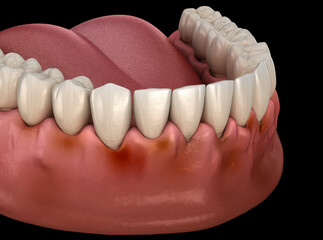 Gingivitis inflammation of the gums. Medically accurate 3D illustration