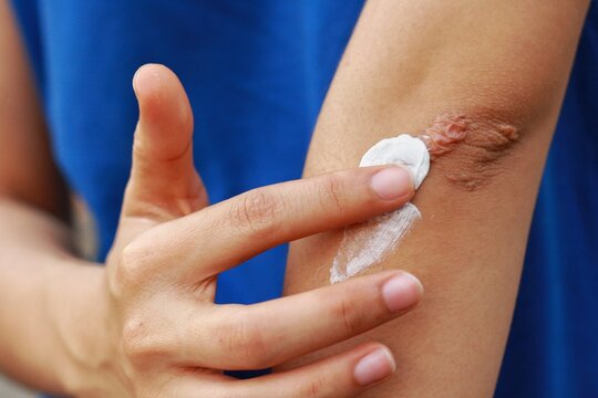 Close up at Asian woman's hand is applying medical cream at  keloid scar (Hypertrophic Scar) at her elbow cause by bicycle accidental.Concepts of health care and beauty.
