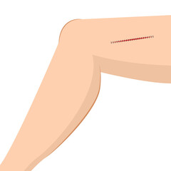 Suture on leg. Sewing on leg cartoon vector. free space for text. copy space.