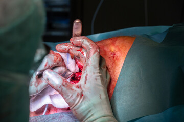 doctor performs a titanium screws explatation in operating room