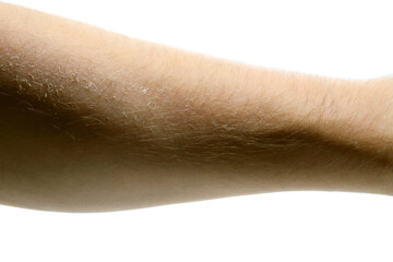 Close up of an arm with sunburnt dry skin peeling off
