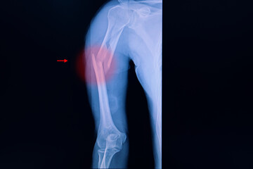 Xray film of an arm with fractured humerus.