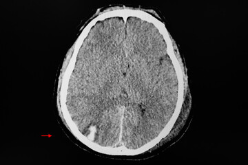 CT brain showing hemorrhagic contusion at right occipital lobe.