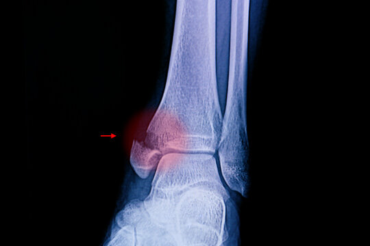 Xray film of an ankle with medial malleolus fracture.