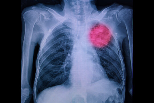 Chest xray of a patient with left upper lung mass.
