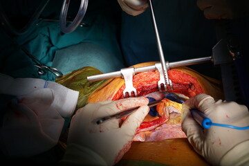 Harvesting the left internal mammary artery (LIMA) for coronary artery bypass graft (CABG).