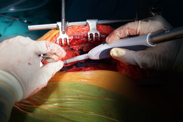 Harvesting the left internal mammary artery (LIMA) for coronary artery bypass graft (CABG).