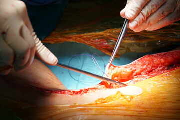 Suture leg wound after successful harvest saphenous vein graft.
