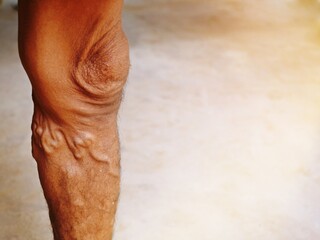 Fototapeta premium The severity of the varicose veins ranges from the tiny capillaries, pain in the legs, swollen feet and legs, and the crooked aneurysm resembles a worm.