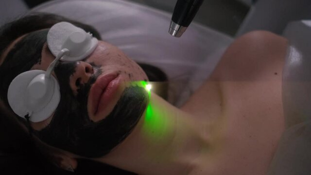 Carbon peeling of the face of a young beautiful girl. Skin care cosmetology. Laser therapy and skin treatment.